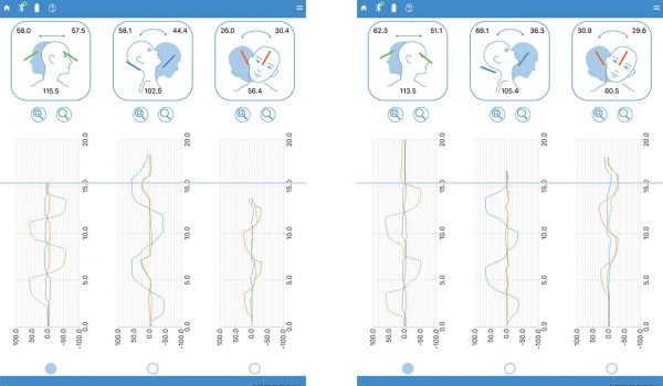 Valutazione dell’efficacia del trattamento osteopatico sul tratto cervicale con sensore S9 2